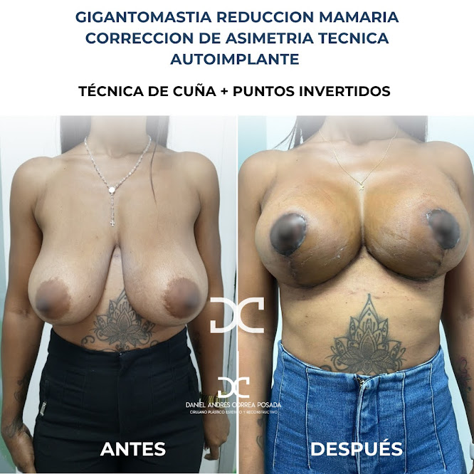 Antes y después de reducción Mamaria con autoimplante