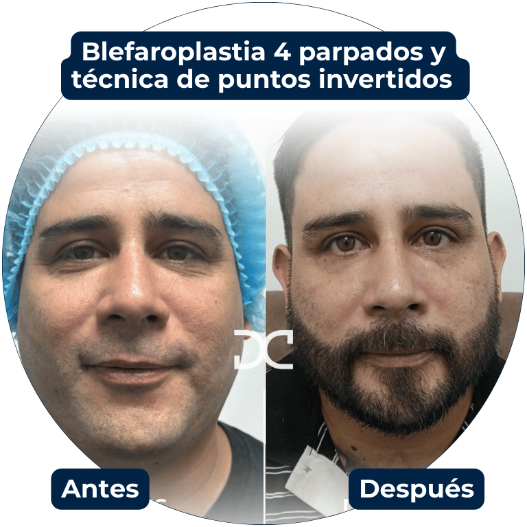 Blefaroplastia 4 parpados y técnica de puntos invertidos