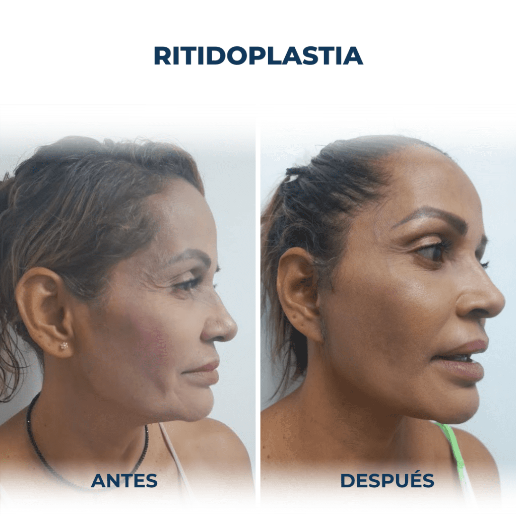 Ritidoplastia