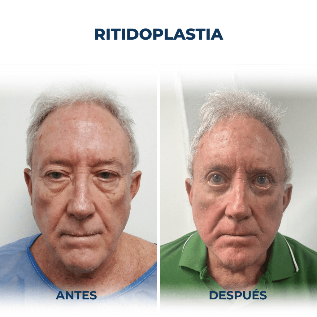 Ritidoplastia