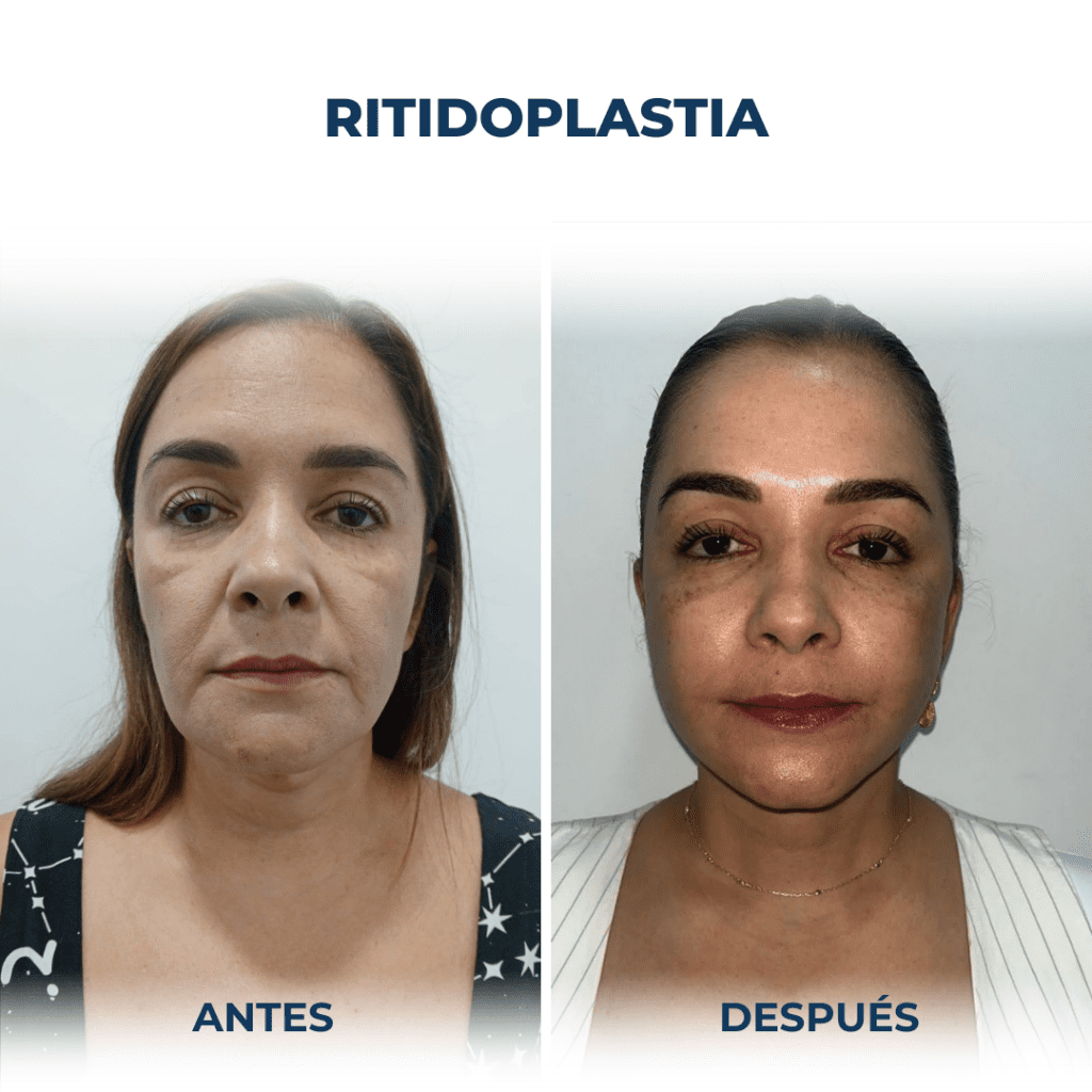 Ritidoplastia