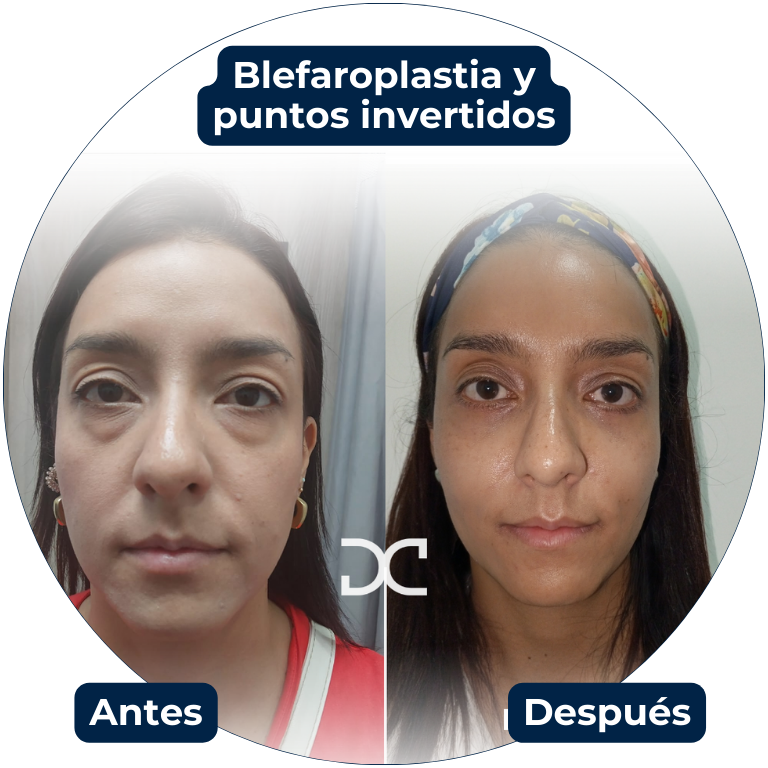 Blefaroplastia y puntos invertidos