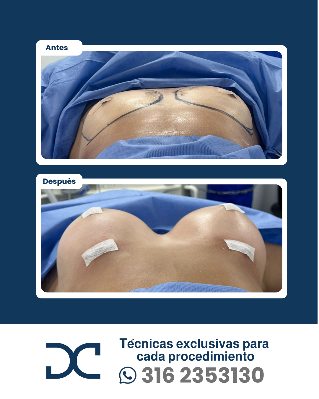 Plantilla DC - Antes y después