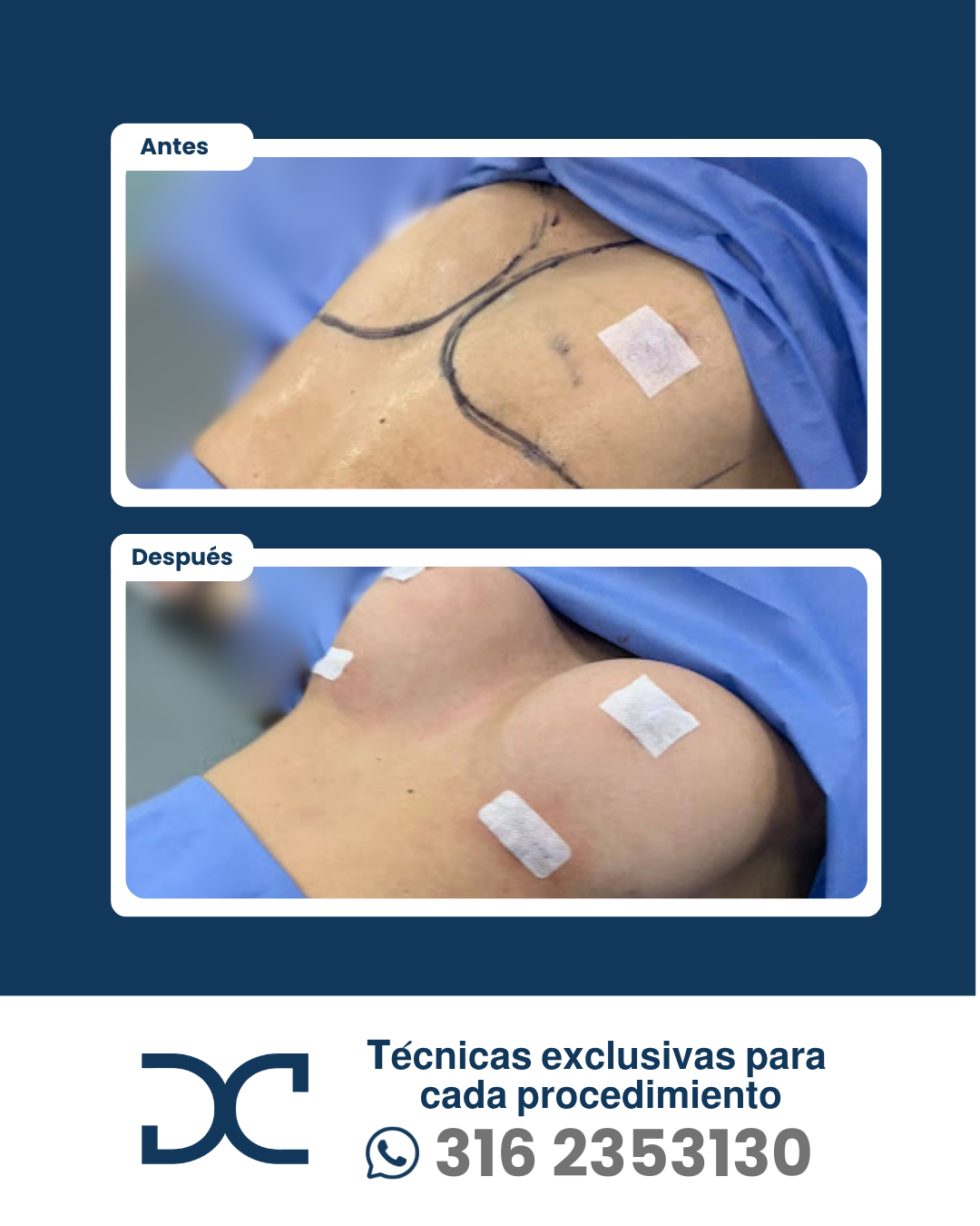 Plantilla DC - Antes y después