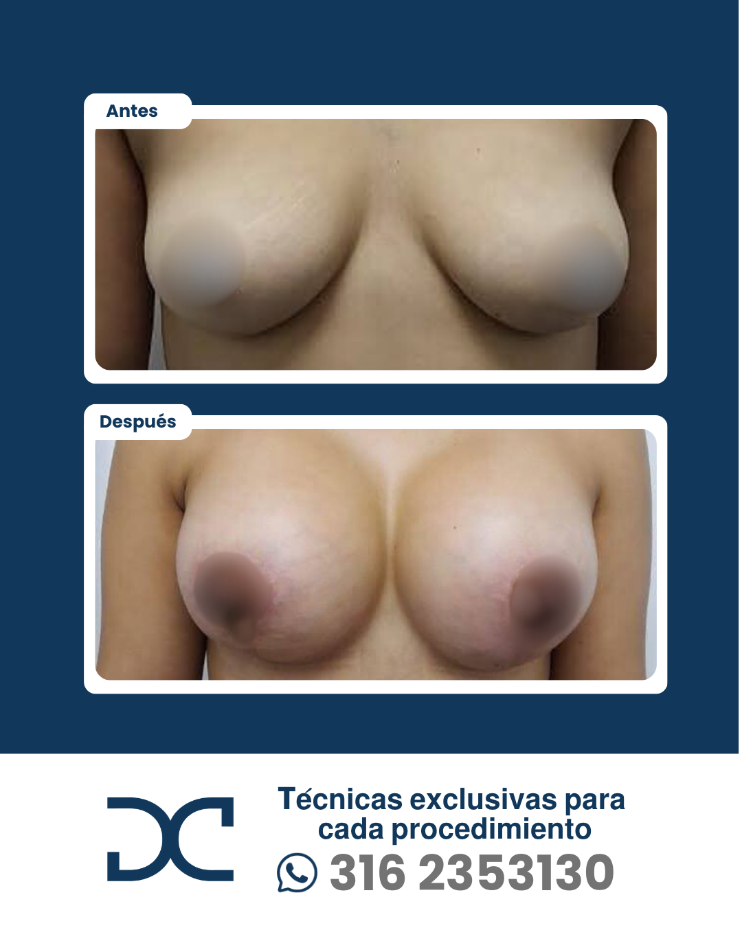 Plantilla DC - Antes y después