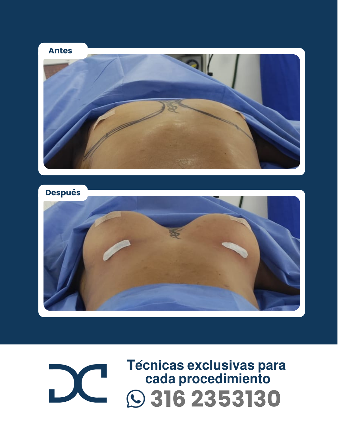 Plantilla DC - Antes y después