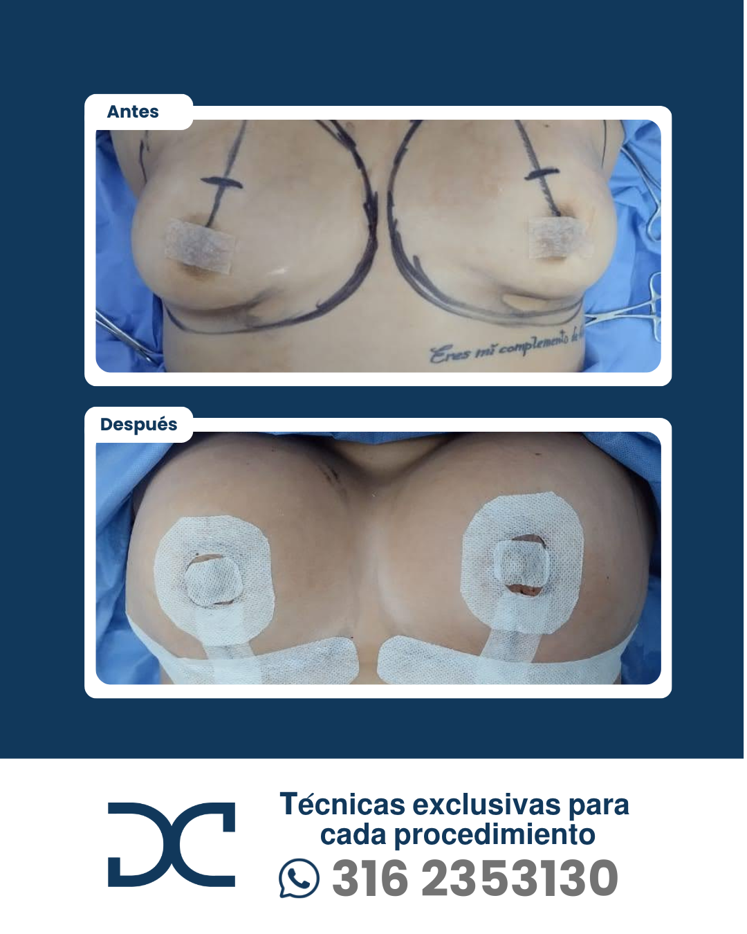 Plantilla DC - Antes y después