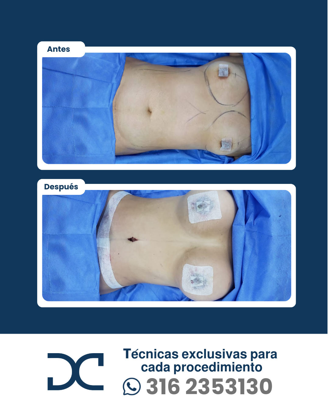 Plantilla DC - Antes y después