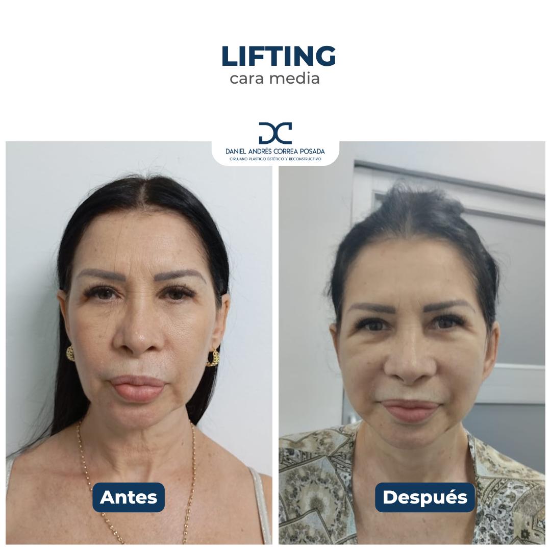 Plantilla DC - Antes y después (1)