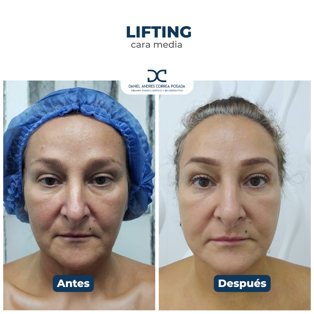 Plantilla DC - Antes y después