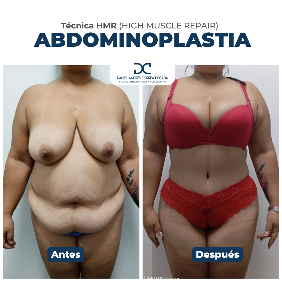 Abdominoplastia tecnica hmr