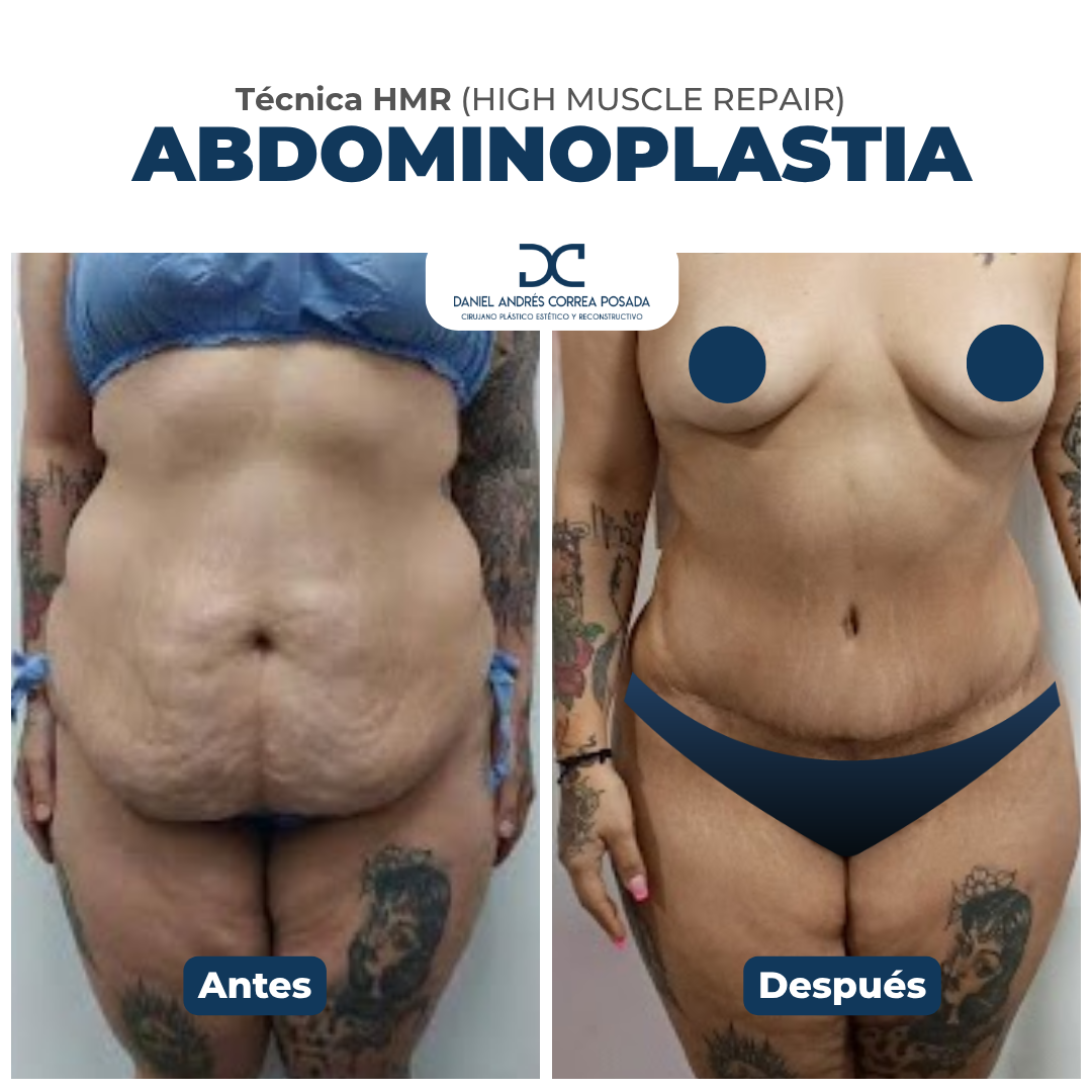 Abdominoplastia tecnica hmr
