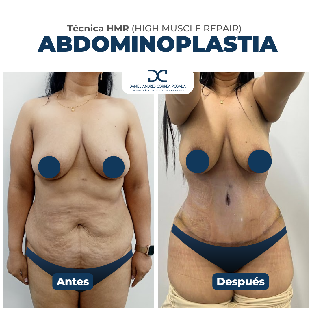 Abdominoplastia tecnica hmr
