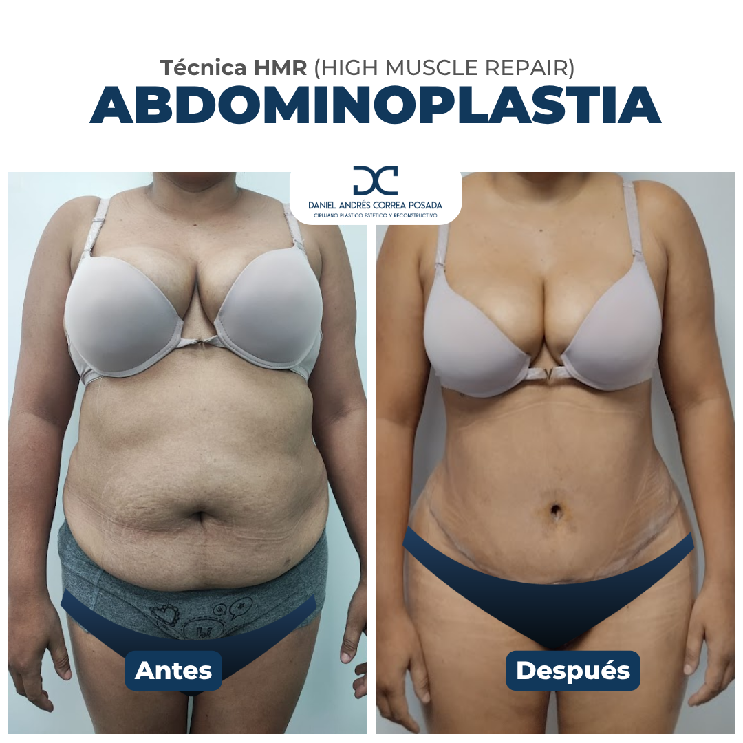 Abdominoplastia tecnica hmr